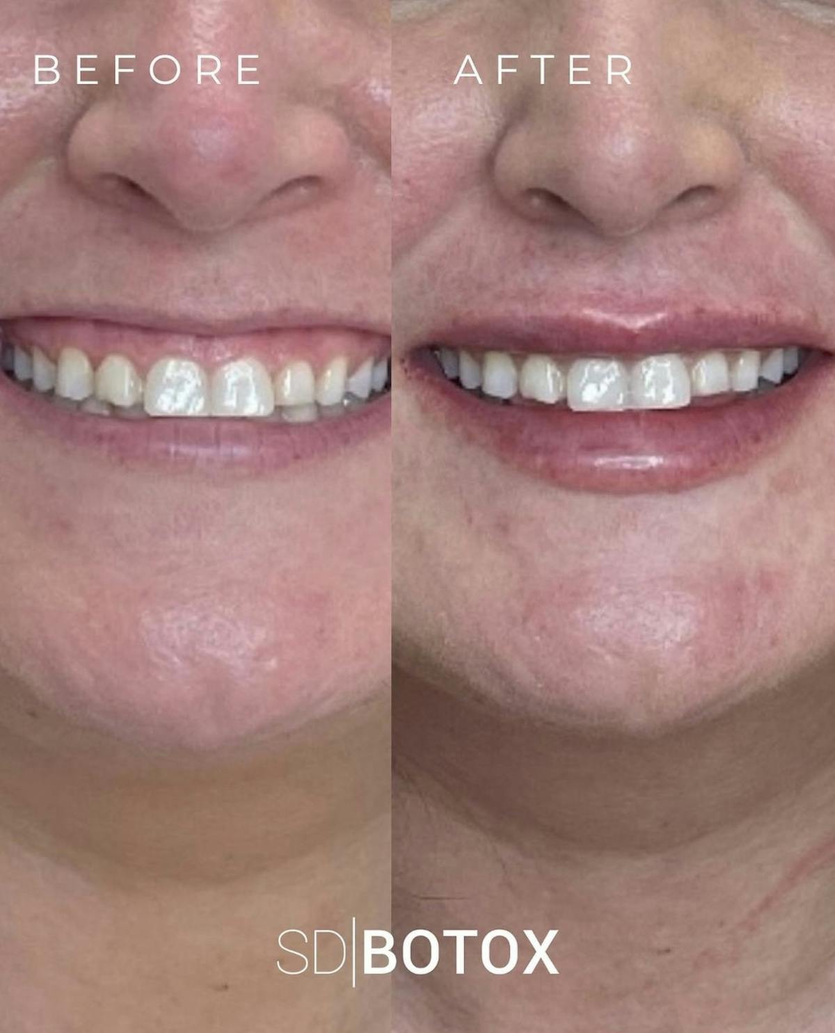 Lip Filler Before & After Gallery - Patient 187074708 - Image 1