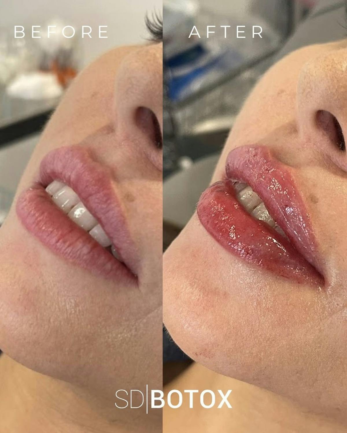 Lip Filler Before & After Gallery - Patient 187074709 - Image 1