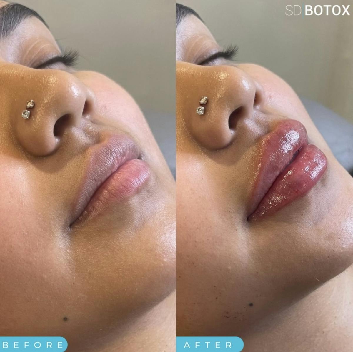 Lip Filler Before & After Gallery - Patient 187074710 - Image 1
