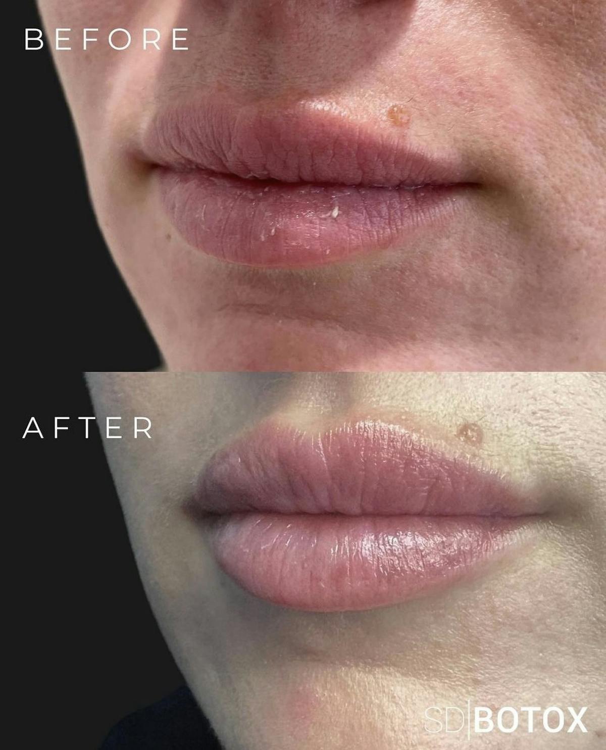 Lip Filler Before & After Gallery - Patient 187074931 - Image 1