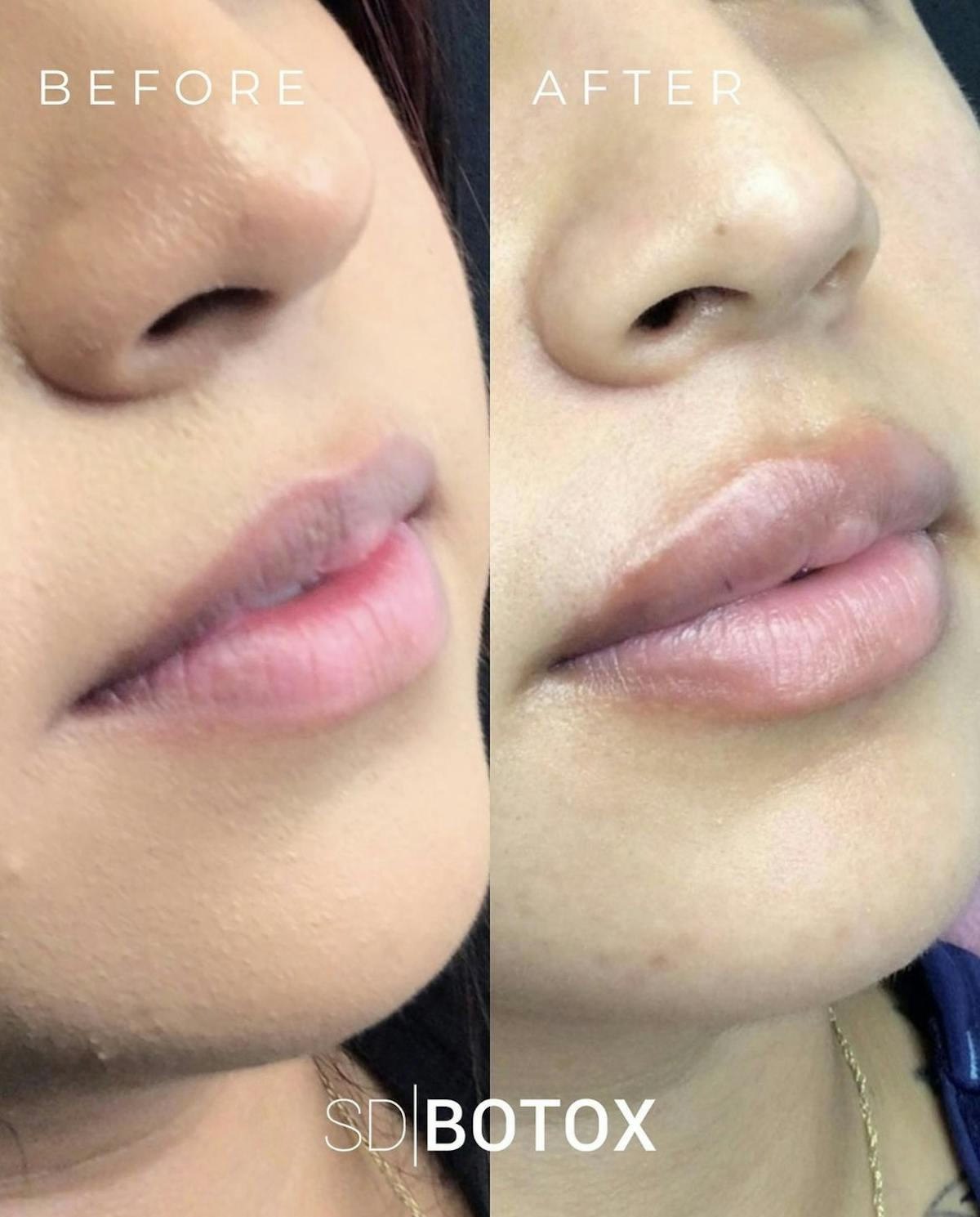 Lip Filler Before & After Gallery - Patient 187074932 - Image 1