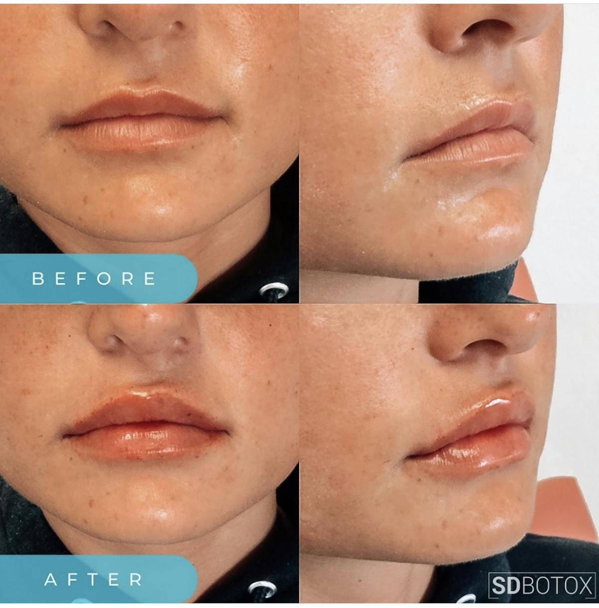 Lip Filler Before & After Gallery - Patient 187074934 - Image 1