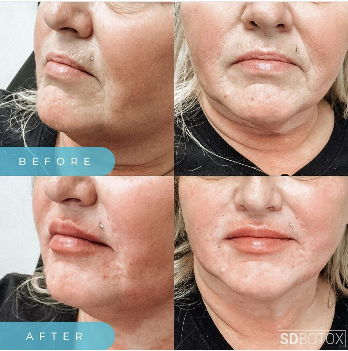 Lip Filler Before & After Gallery - Patient 187074935 - Image 1