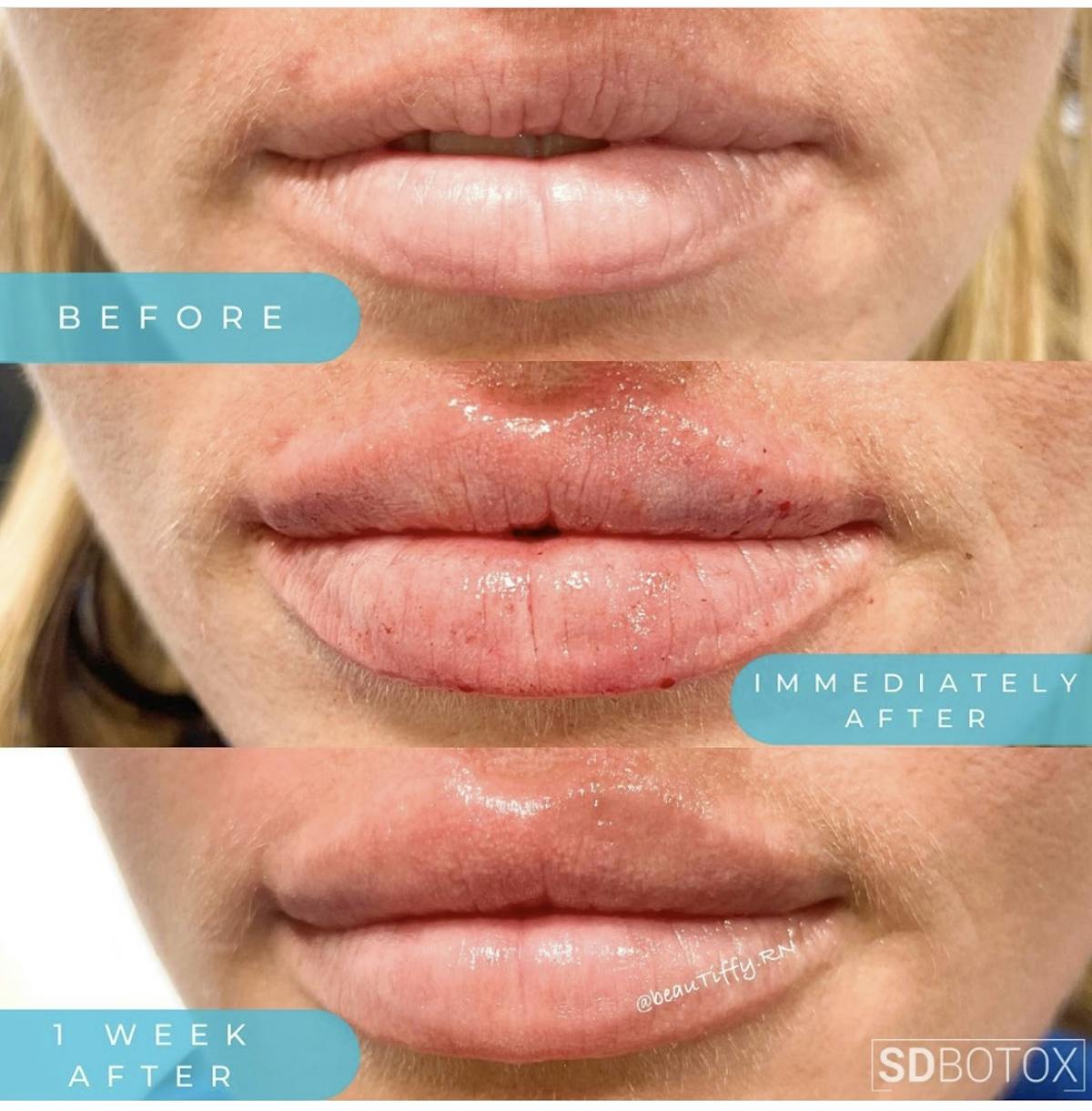Lip Filler Before & After Gallery - Patient 187074936 - Image 1