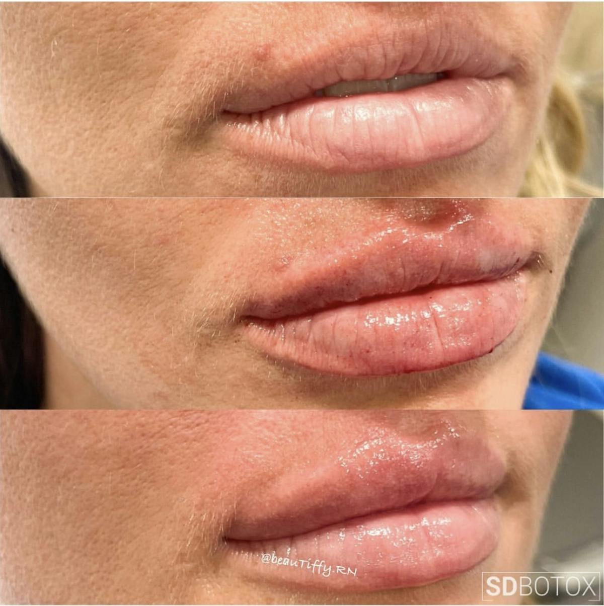 Lip Filler Before & After Gallery - Patient 187074936 - Image 2