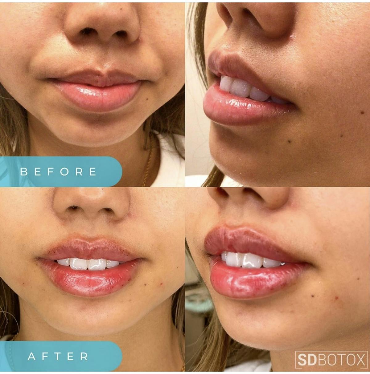 Lip Filler Before & After Gallery - Patient 187076390 - Image 1