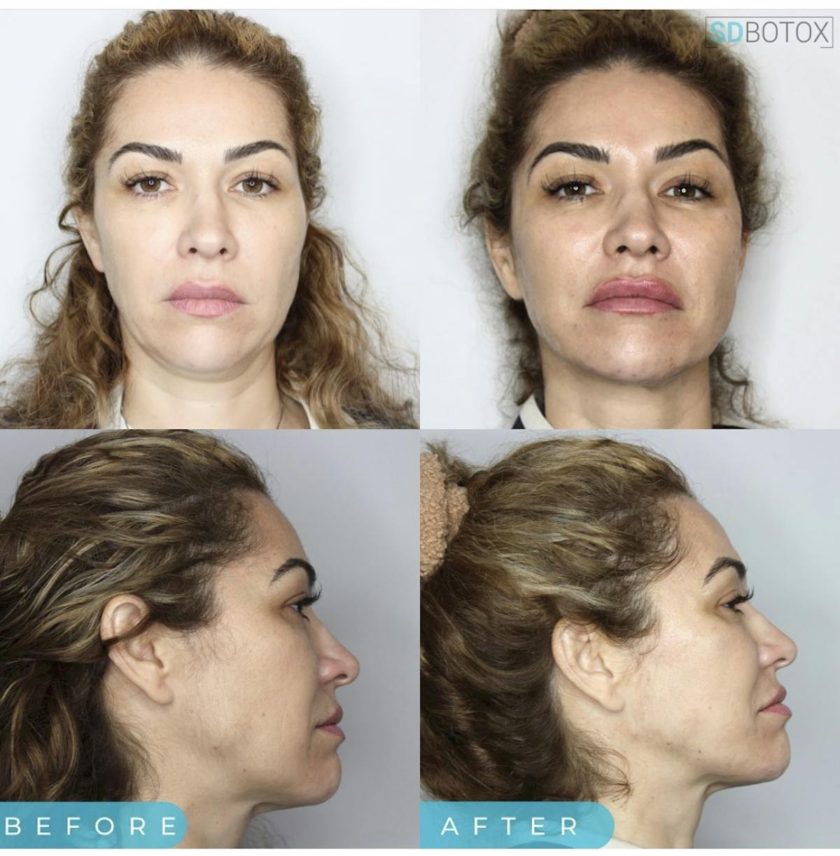Lip Filler Before & After Gallery - Patient 187076392 - Image 1