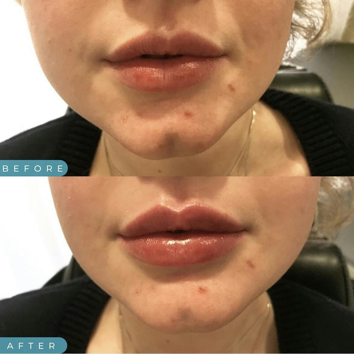 Lip Filler Before & After Gallery - Patient 187076393 - Image 1