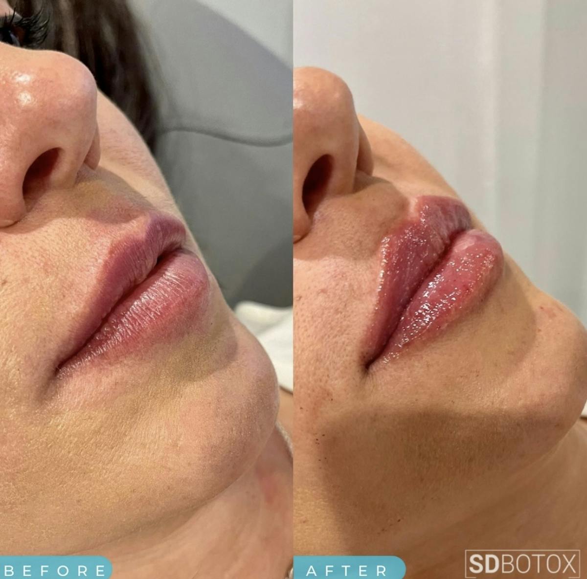 Lip Filler Before & After Gallery - Patient 187076395 - Image 1