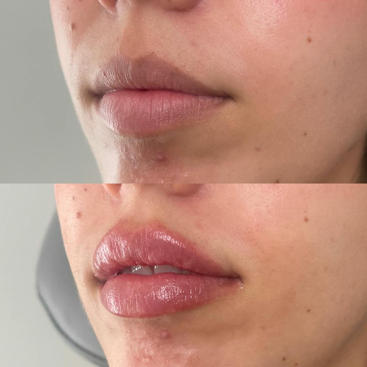 Lip Filler Before & After Gallery - Patient 187076396 - Image 2