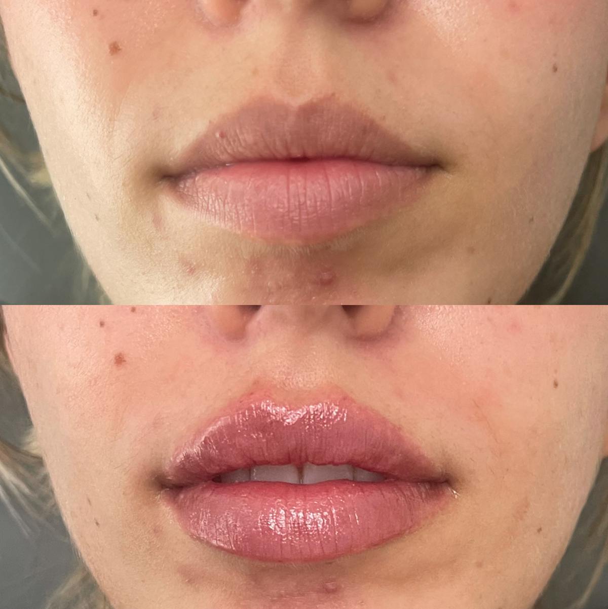 Lip Filler Before & After Gallery - Patient 187076396 - Image 1