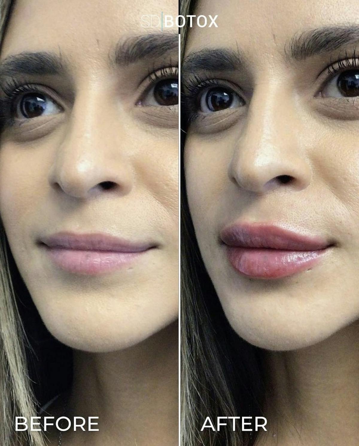 Lip Filler Before & After Gallery - Patient 187076397 - Image 1