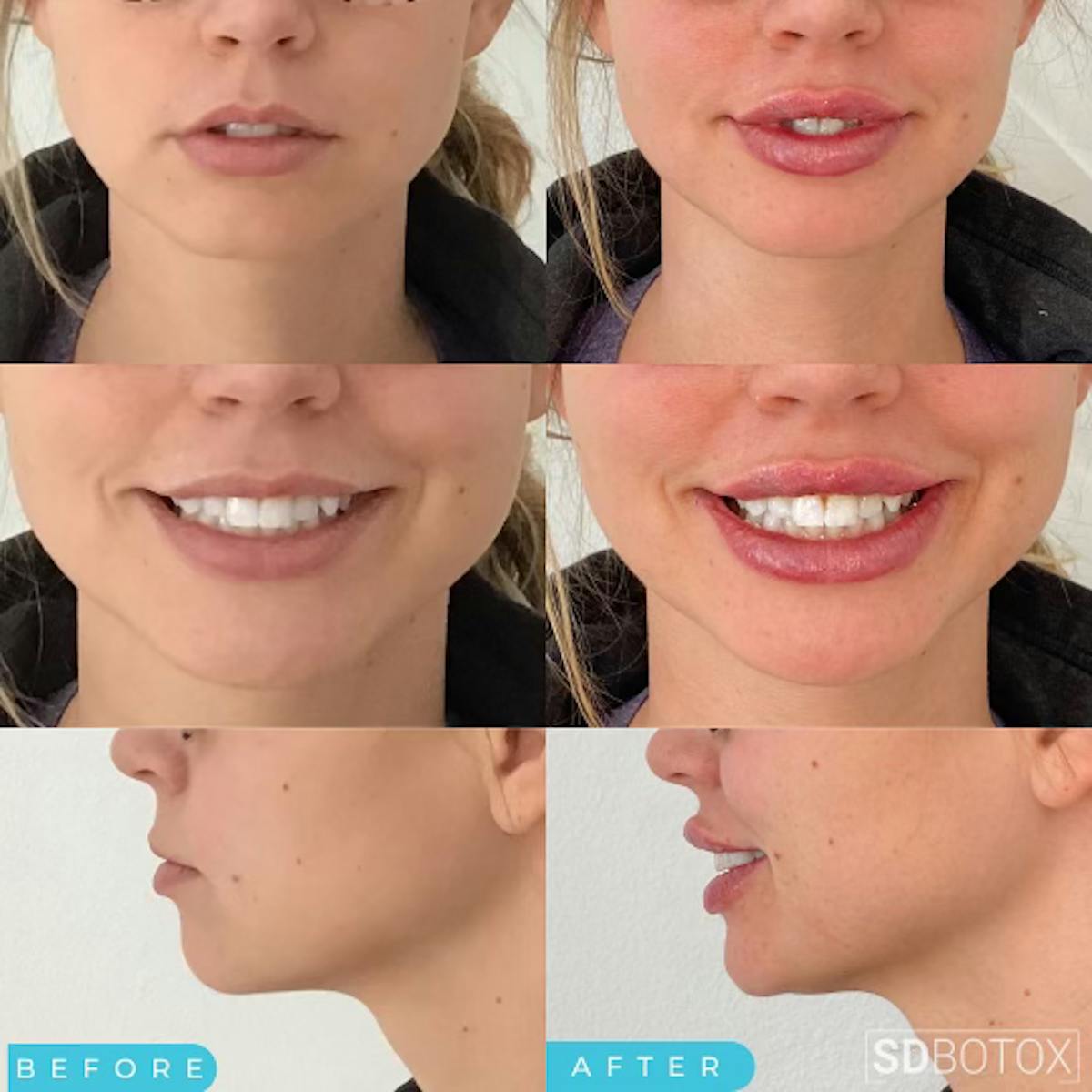 Lip Filler Before & After Gallery - Patient 187076398 - Image 1