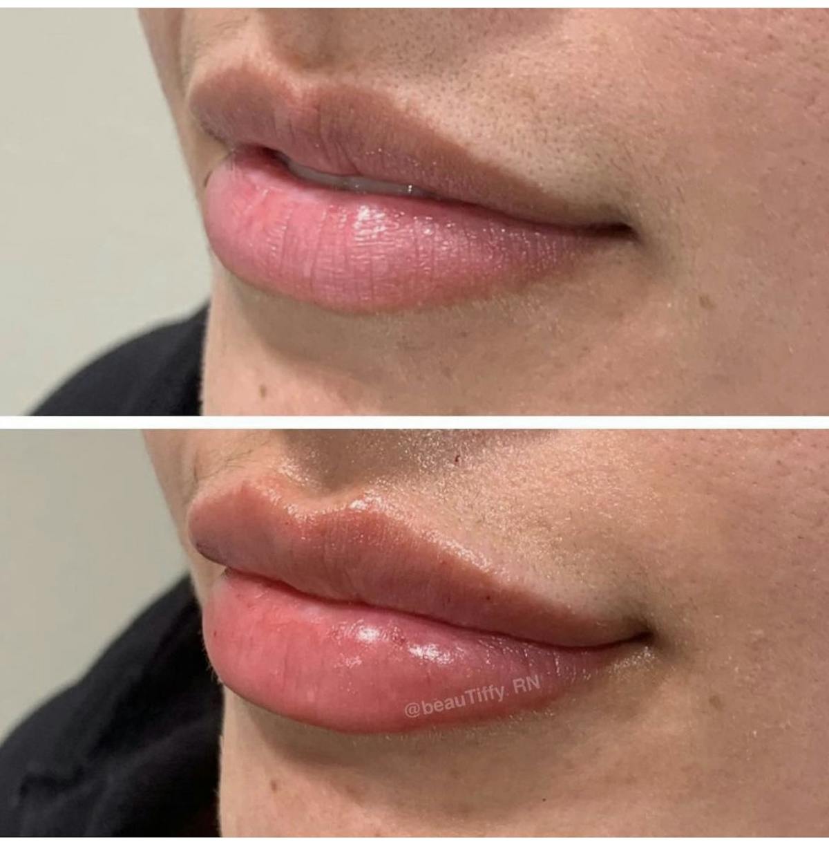 Lip Filler Before & After Gallery - Patient 187076399 - Image 2