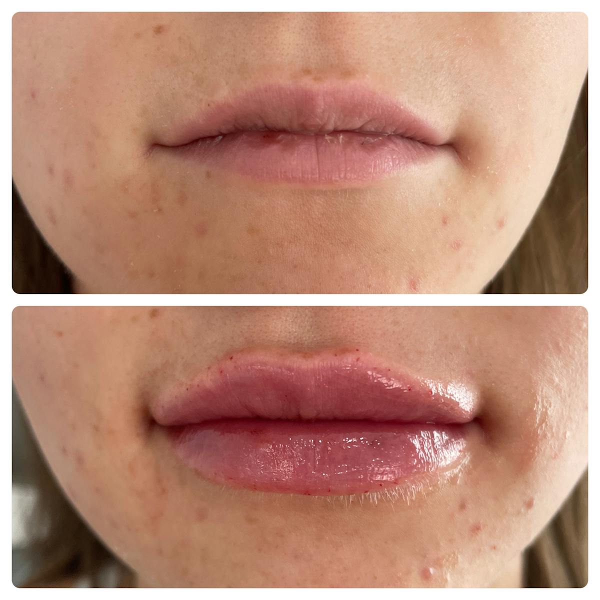 Lip Filler Before & After Gallery - Patient 187076400 - Image 1
