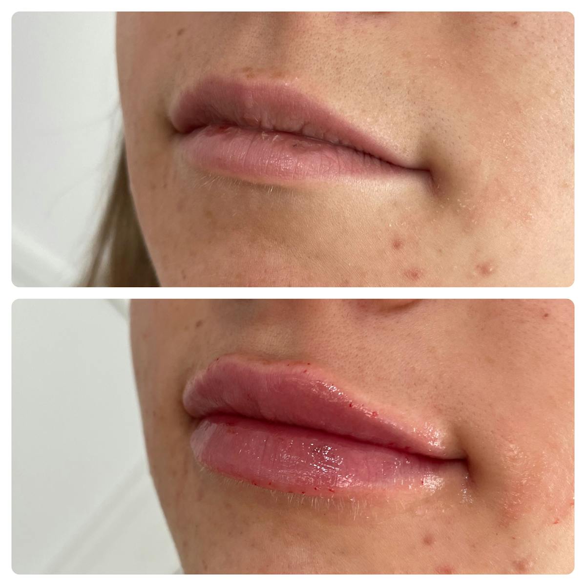 Lip Filler Before & After Gallery - Patient 187076400 - Image 2