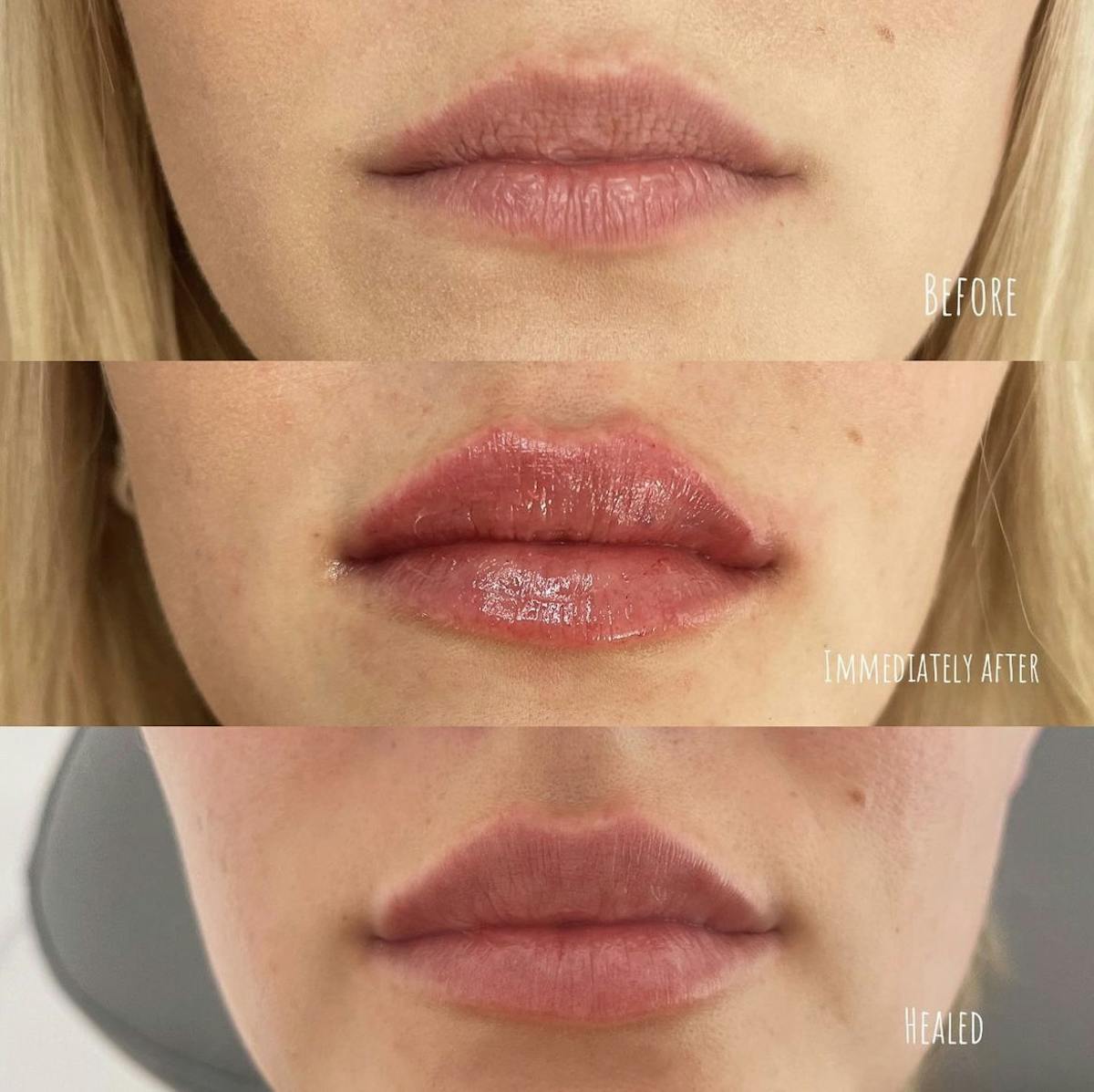 Lip Filler Before & After Gallery - Patient 187076401 - Image 1