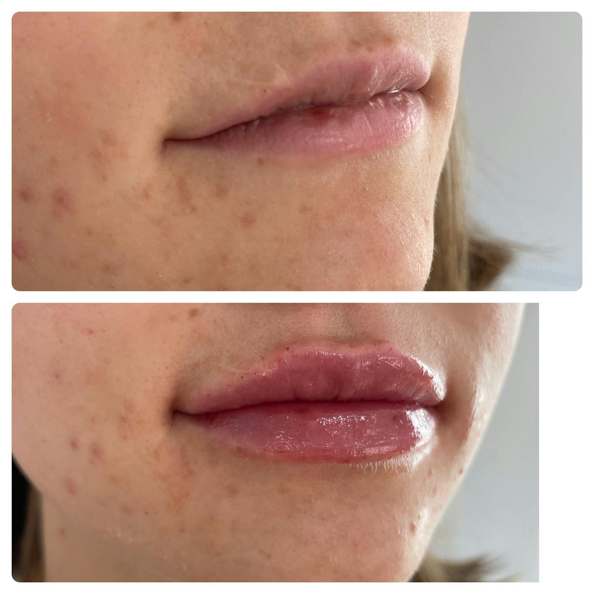Lip Filler Before & After Gallery - Patient 187076402 - Image 1