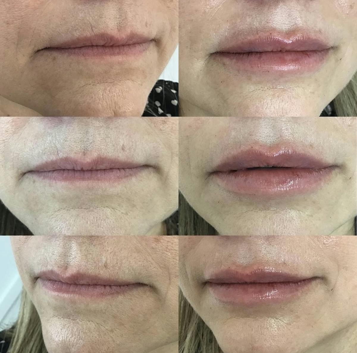 Lip Filler Before & After Gallery - Patient 187076403 - Image 1