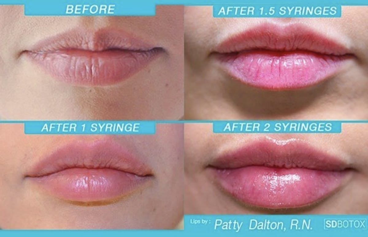 Lip Filler Before & After Gallery - Patient 187076404 - Image 1
