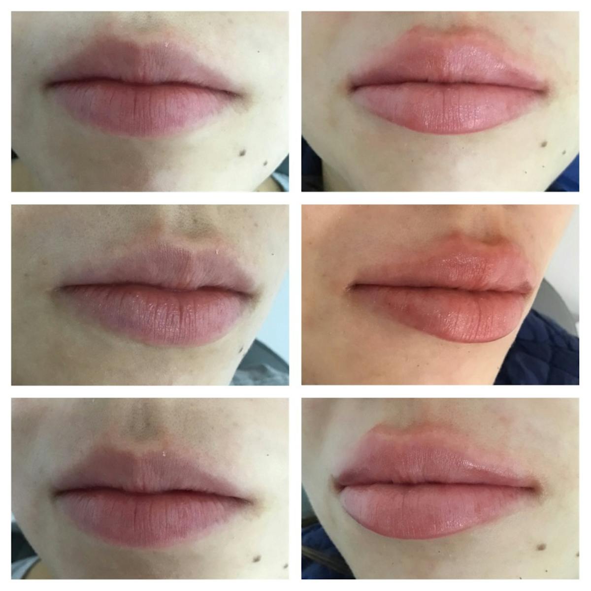 Lip Filler Before & After Gallery - Patient 187083507 - Image 1