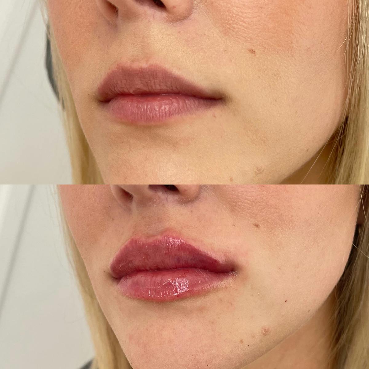 Lip Filler Before & After Gallery - Patient 187083749 - Image 2