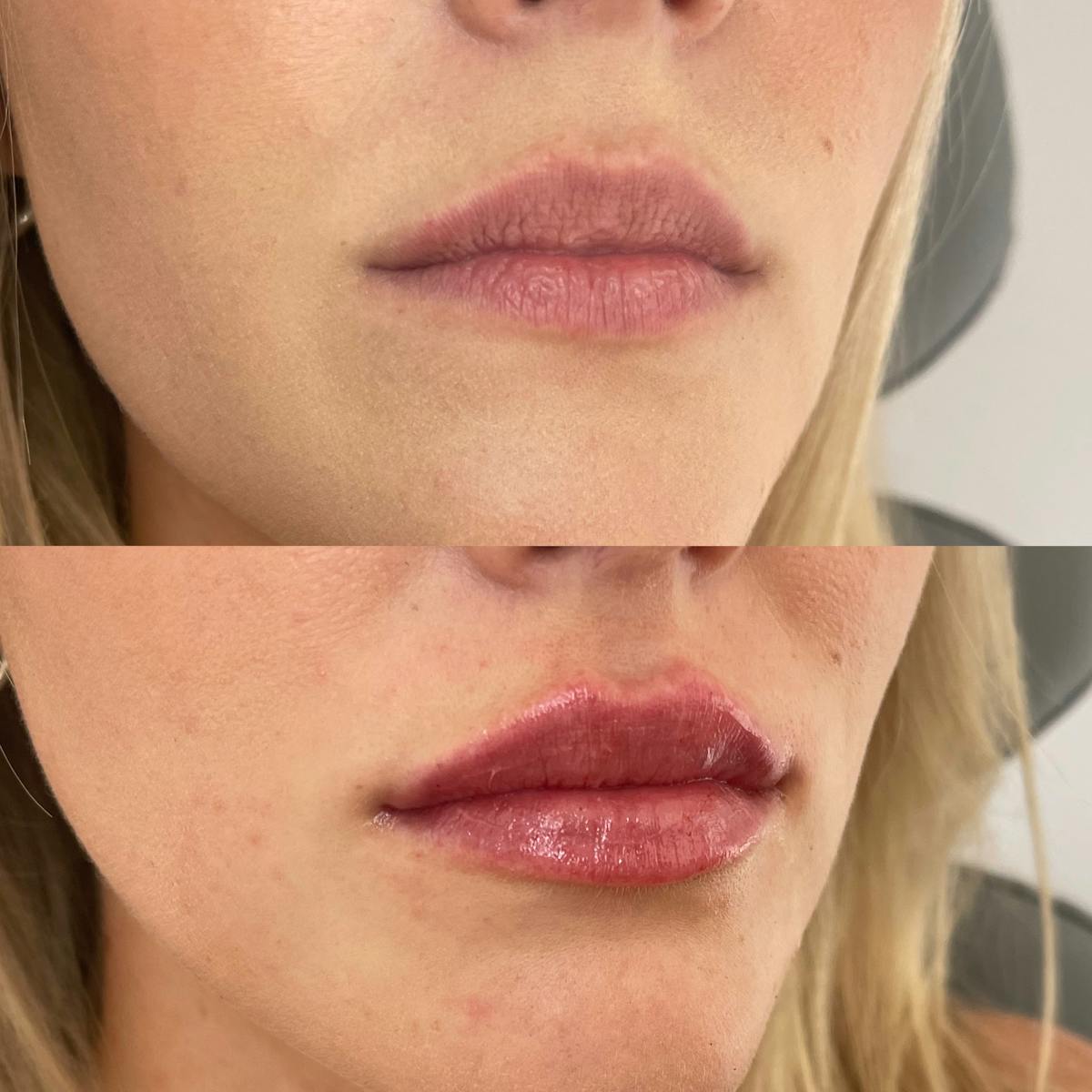 Lip Filler Before & After Gallery - Patient 187083749 - Image 3
