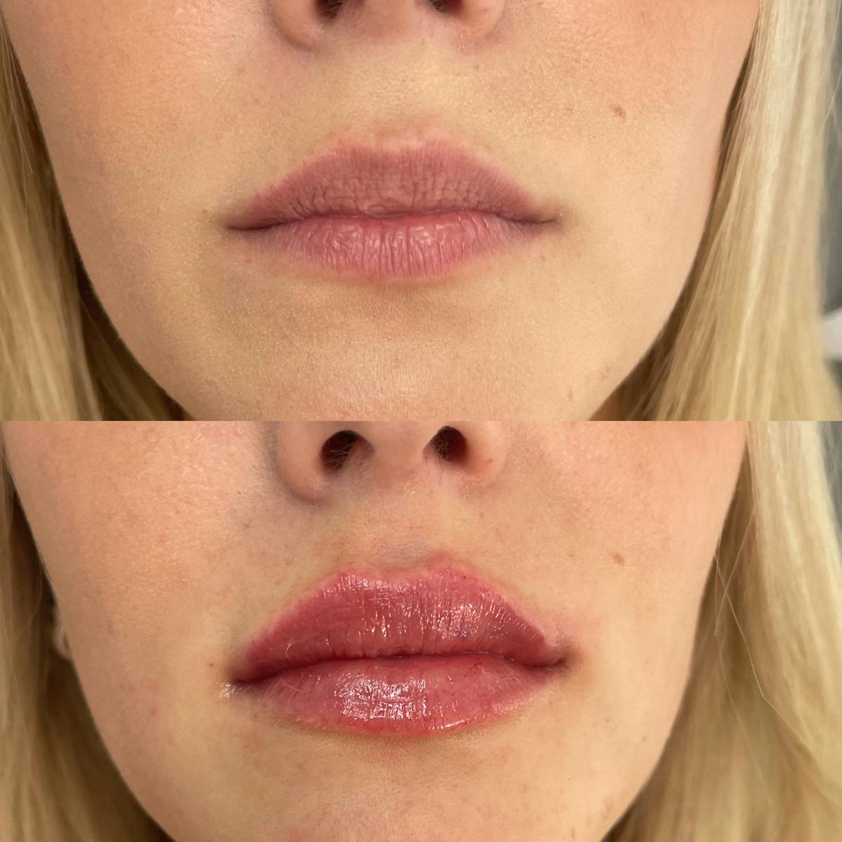 Lip Filler Before & After Gallery - Patient 187083749 - Image 1