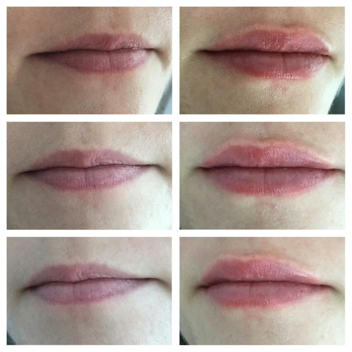 Lip Filler Before & After Gallery - Patient 187083747 - Image 1