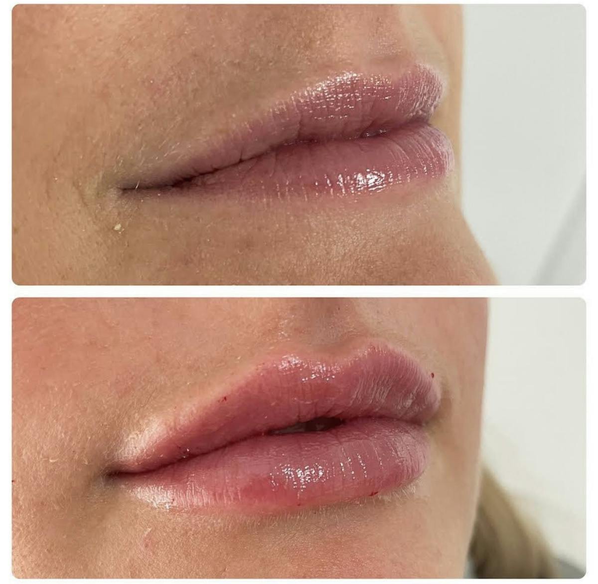Lip Filler Before & After Gallery - Patient 187084137 - Image 1