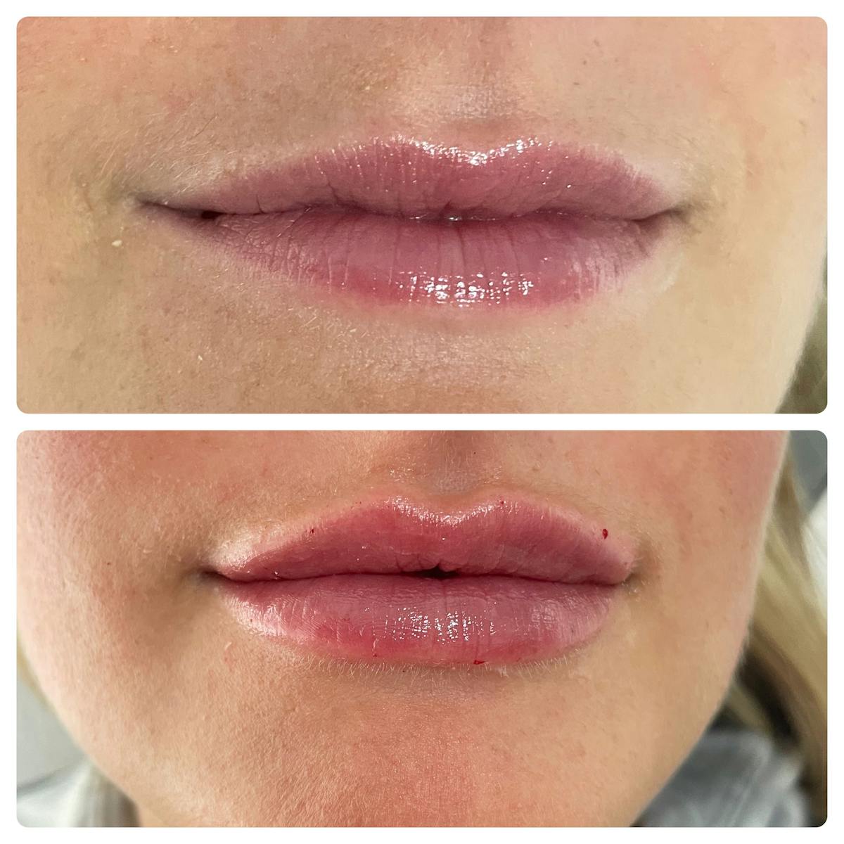Lip Filler Before & After Gallery - Patient 187084137 - Image 2