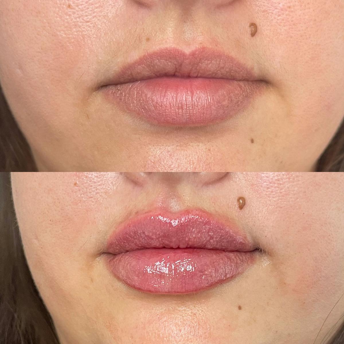 Lip Filler Before & After Gallery - Patient 187084138 - Image 1