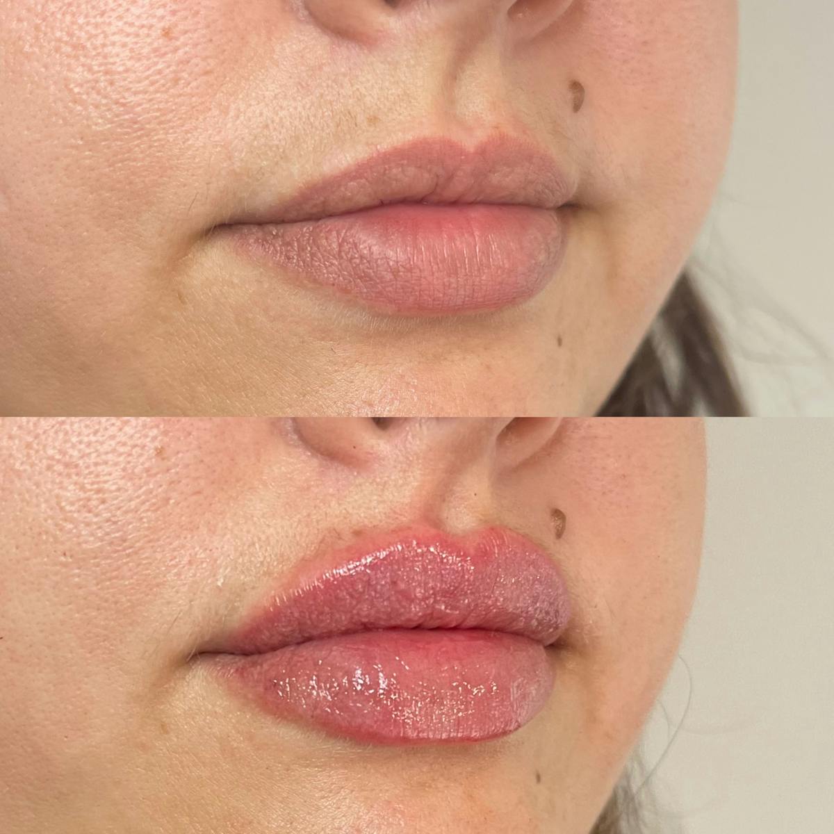 Lip Filler Before & After Gallery - Patient 187084138 - Image 2