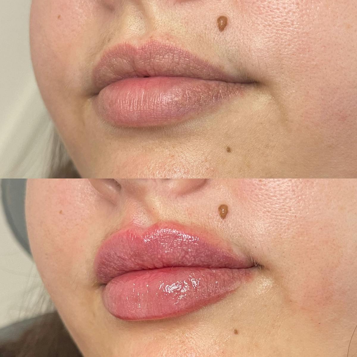 Lip Filler Before & After Gallery - Patient 187084138 - Image 3