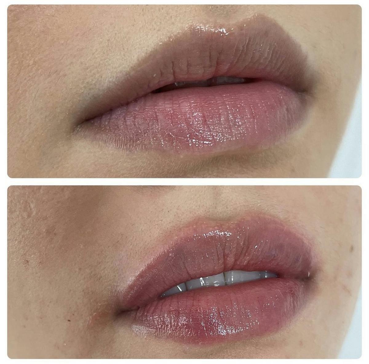 Lip Filler Before & After Gallery - Patient 187084139 - Image 1
