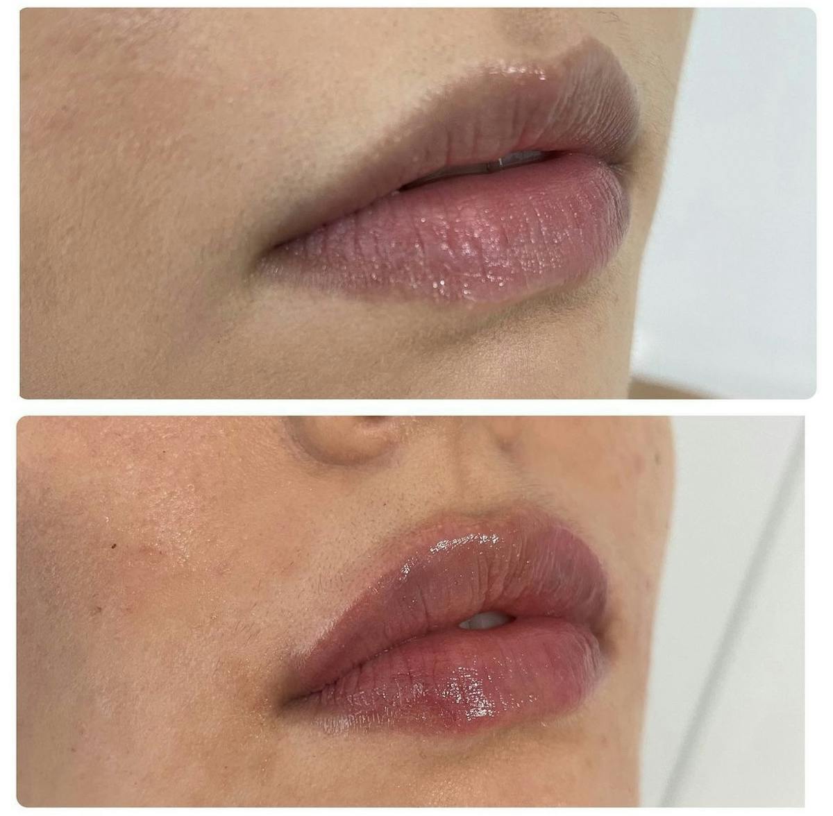 Lip Filler Before & After Gallery - Patient 187084139 - Image 2