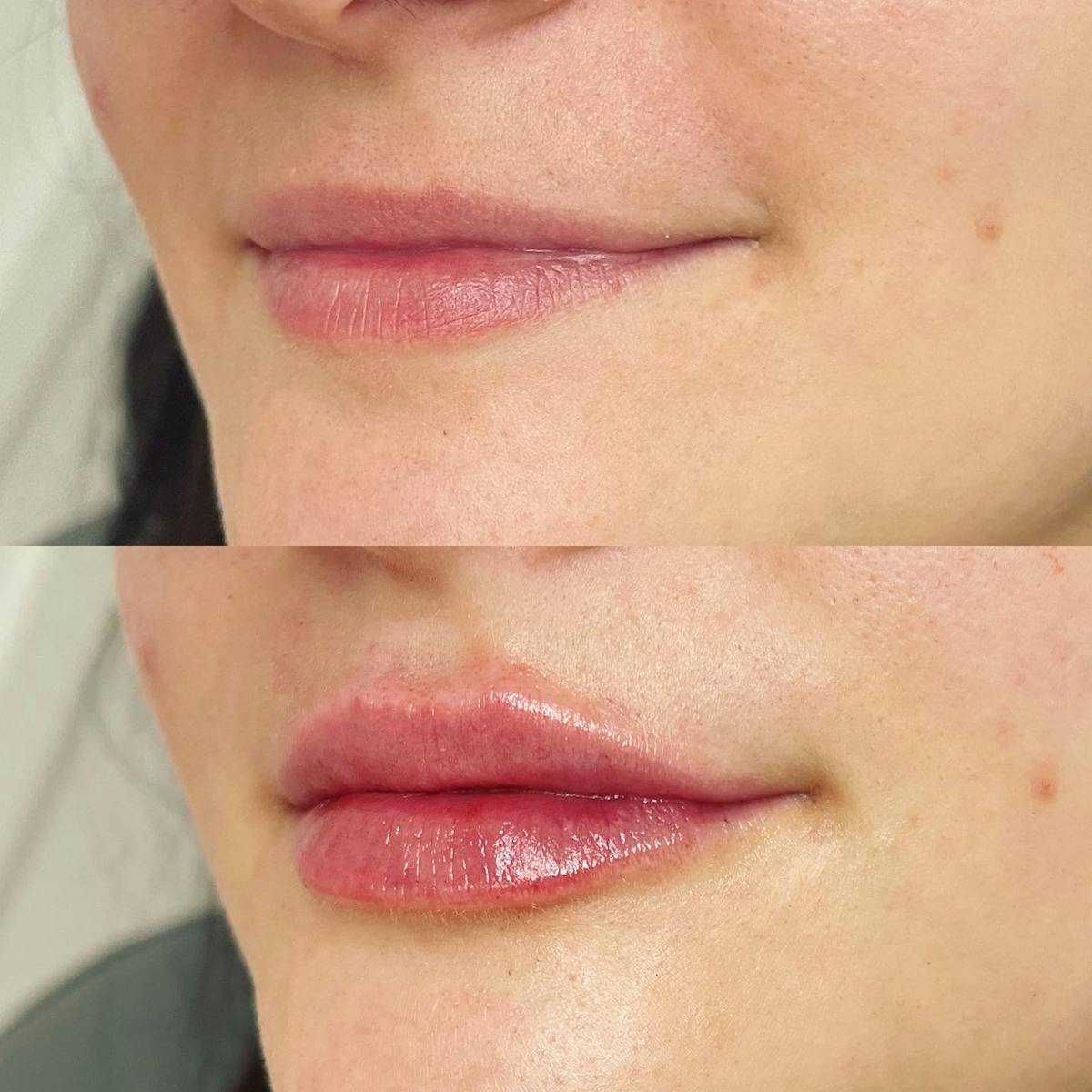 Lip Filler Before & After Gallery - Patient 187084140 - Image 2