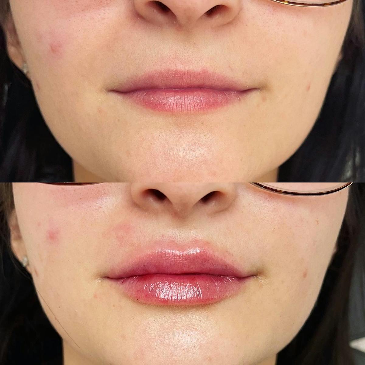 Lip Filler Before & After Gallery - Patient 187084140 - Image 1