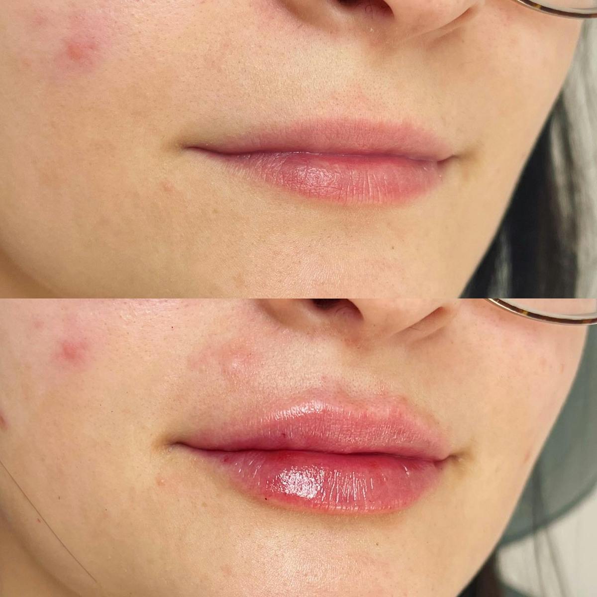 Lip Filler Before & After Gallery - Patient 187084140 - Image 3