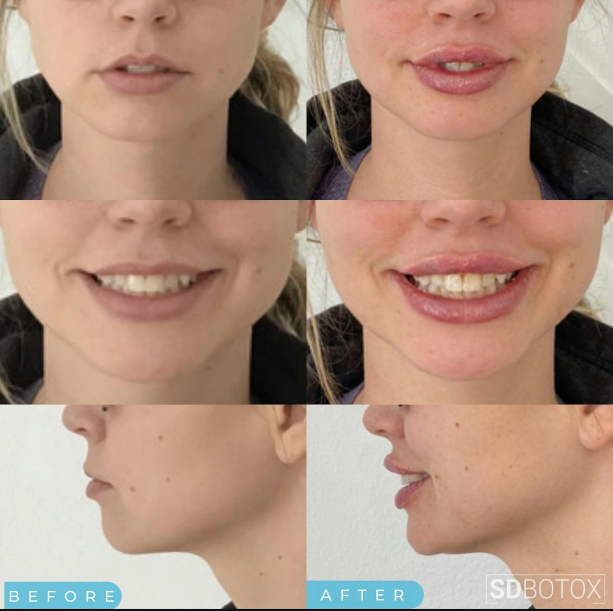 Lip Filler Before & After Gallery - Patient 187084141 - Image 1