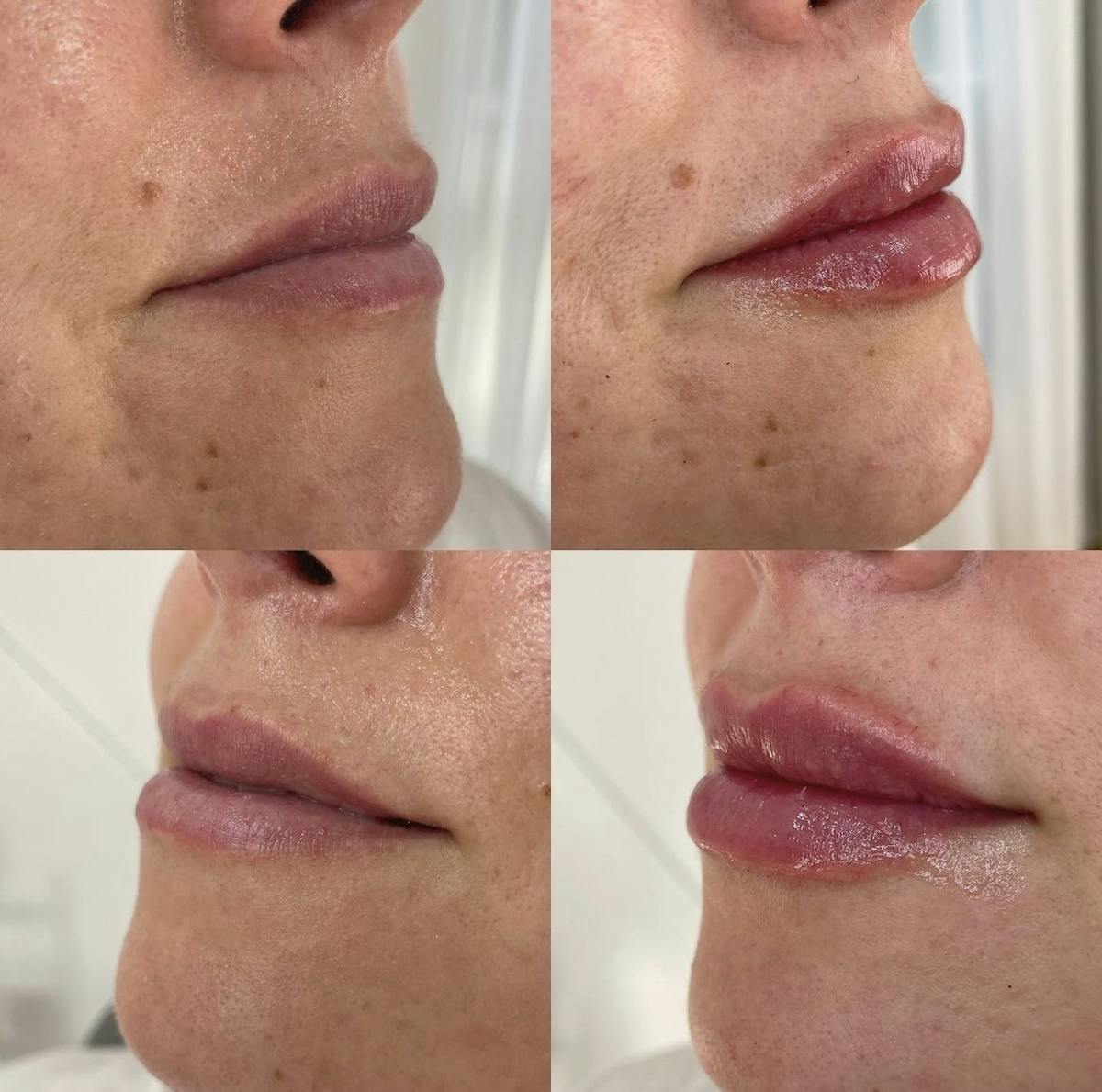 Lip Filler Before & After Gallery - Patient 187084143 - Image 1