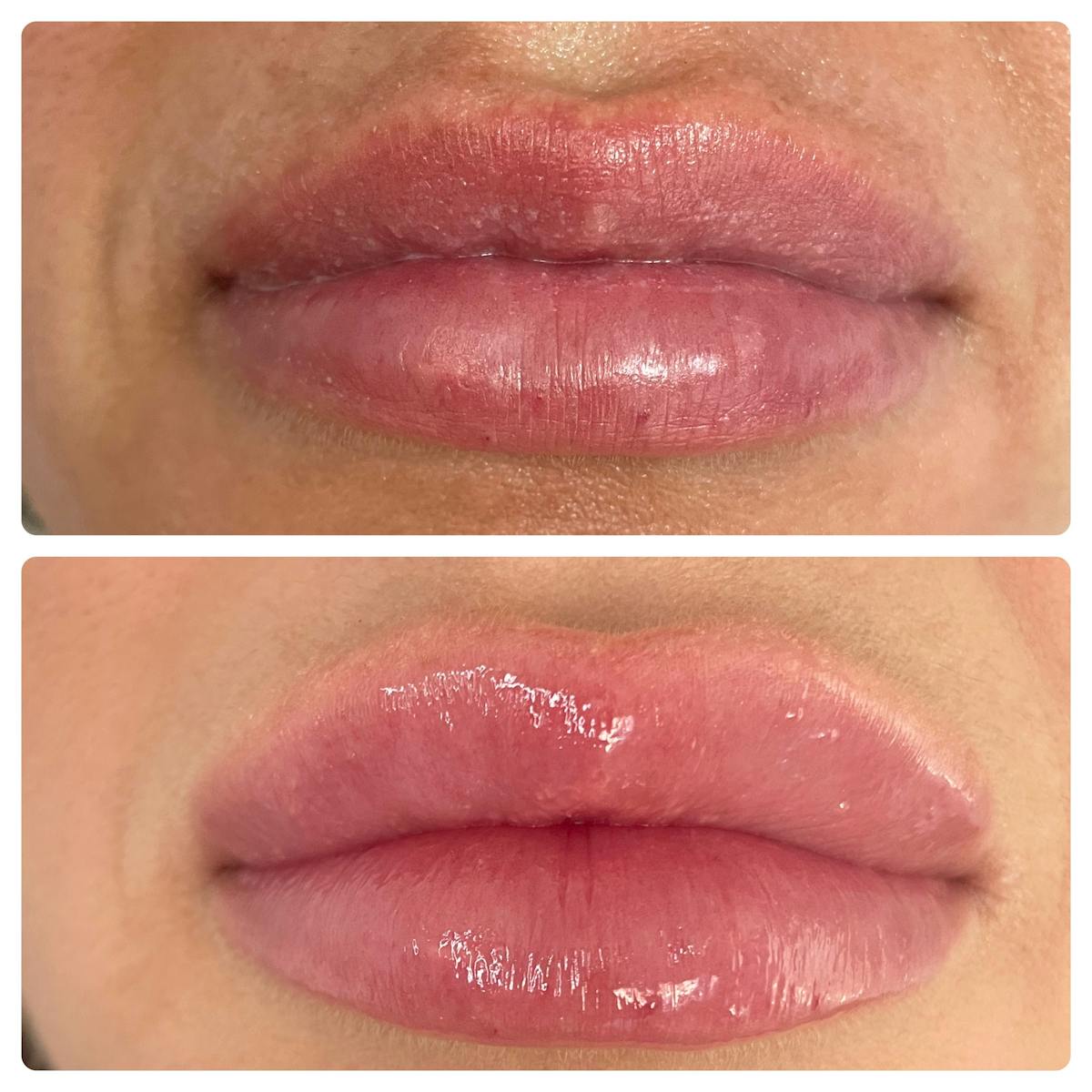 Lip Filler Before & After Gallery - Patient 187084144 - Image 1