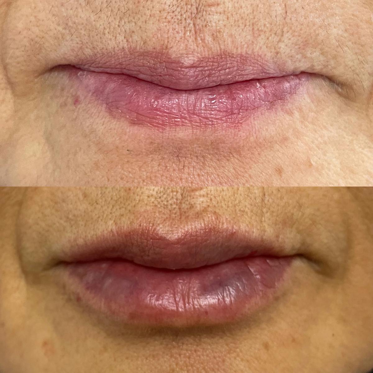 Lip Filler Before & After Gallery - Patient 187084145 - Image 1