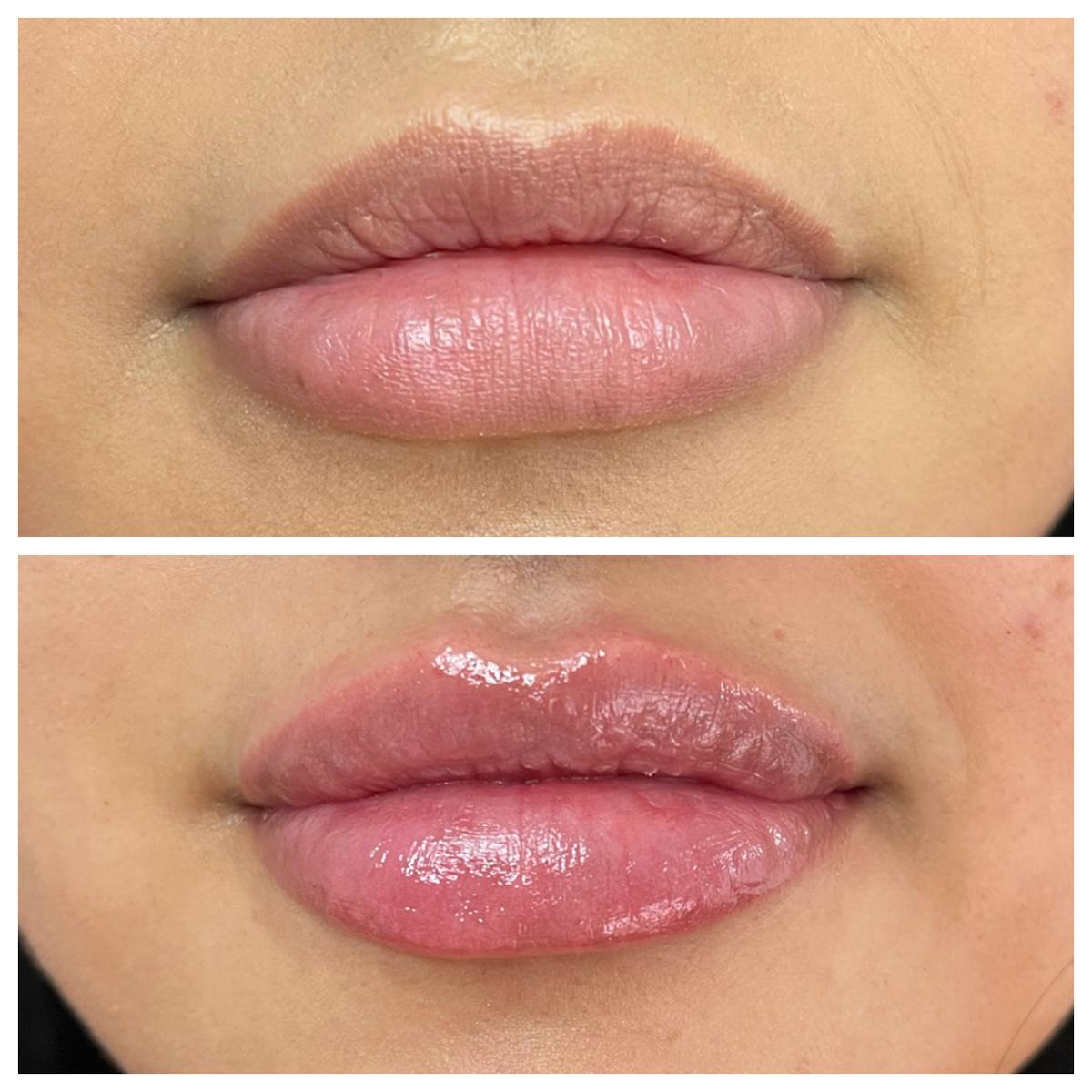 Lip Filler Before & After Gallery - Patient 187084146 - Image 1