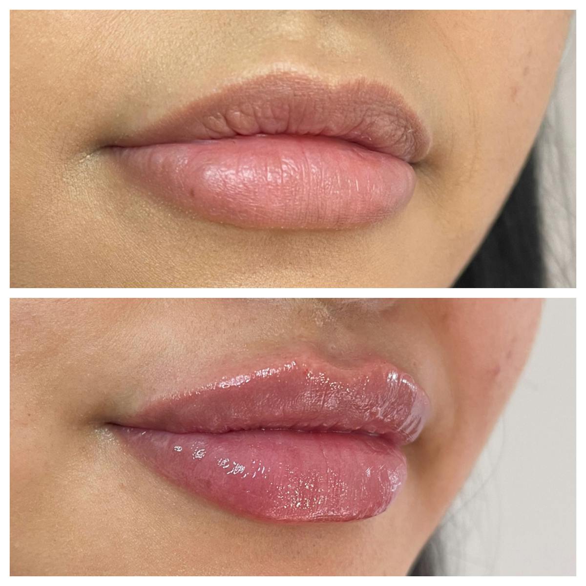 Lip Filler Before & After Gallery - Patient 187084146 - Image 2