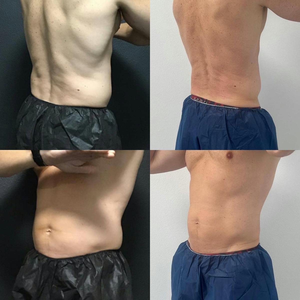 Coolsculpting Before & After Gallery - Patient 187087361 - Image 1