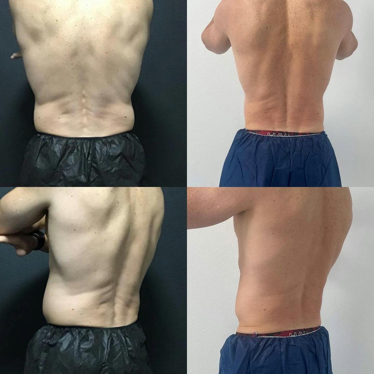 Coolsculpting Before & After Gallery - Patient 187087361 - Image 2