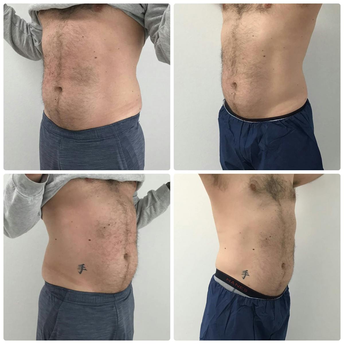 Coolsculpting Before & After Gallery - Patient 187087362 - Image 1