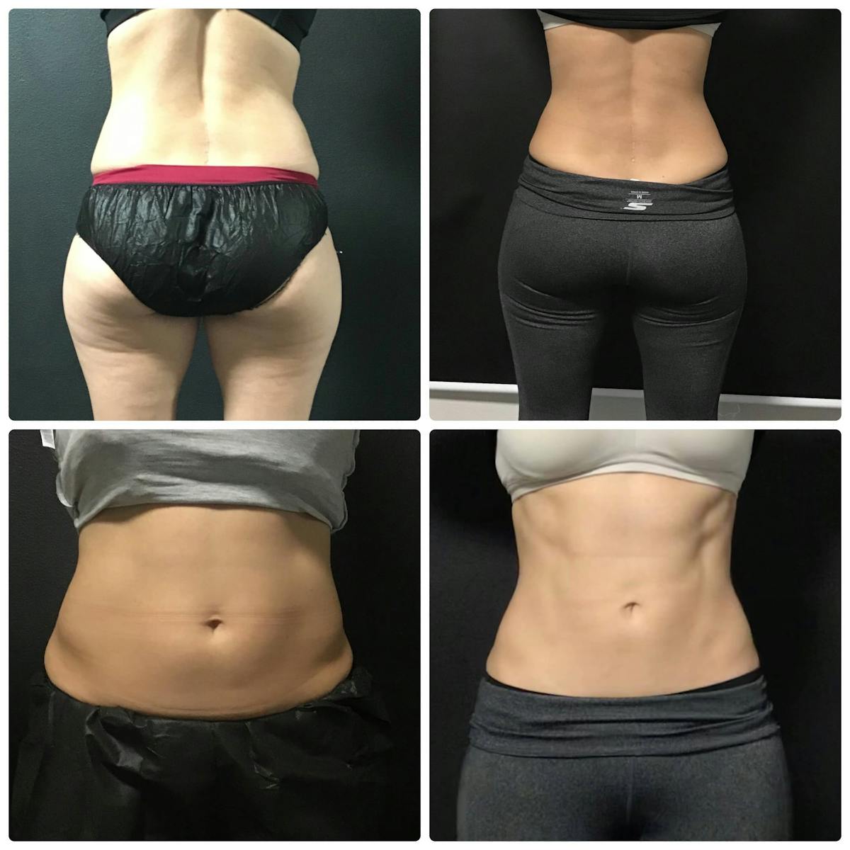 Coolsculpting Before & After Gallery - Patient 187087363 - Image 1