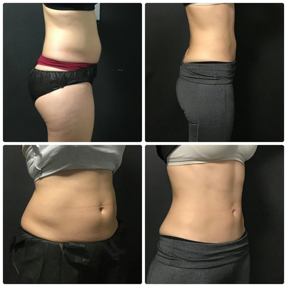 Coolsculpting Before & After Gallery - Patient 187087363 - Image 2